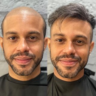 What's the difference between men wearing hair replacement systems before and after?