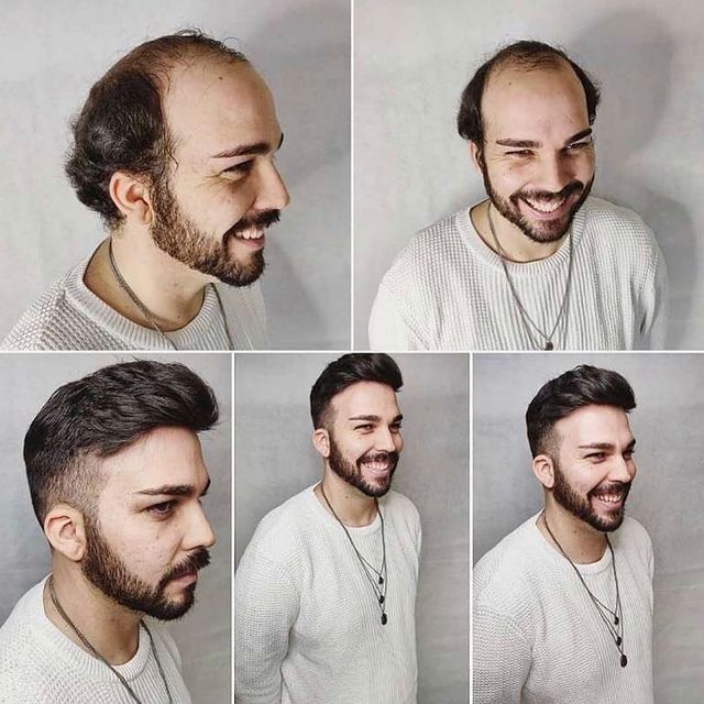 How Can Men with hair loss choose the perfect Hair replacement Systems?